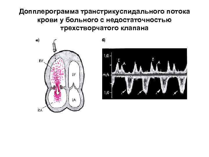 Допплерограмма транстрикуспидального потока крови у больного с недостаточностью трехстворчатого клапана 