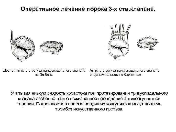 Оперативное лечение порока 3 -х ств. клапана. Шовная аннулопластика трикуспидального клапана по Де Вега.