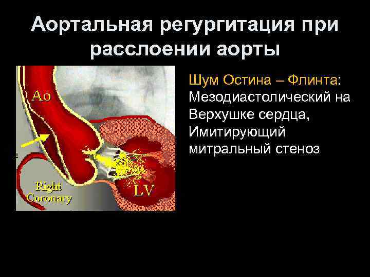 Аортальная регургитация при расслоении аорты Шум Остина – Флинта: Мезодиастолический на Верхушке сердца, Имитирующий