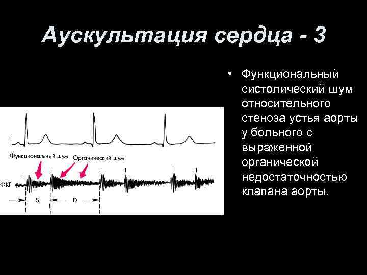 Аускультация сердца - 3 • Функциональный систолический шум относительного стеноза устья аорты у больного