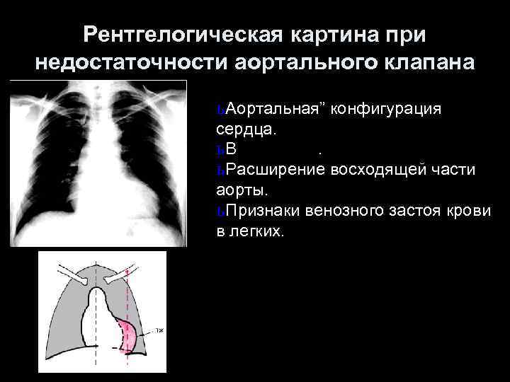 Рентгелогическая картина при недостаточности аортального клапана ь Аортальная” конфигурация сердца. ь. В. ь Расширение