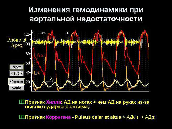 Изменения гемодинамики при аортальной недостаточности Ш Признак Хилла: АД на ногах > чем АД