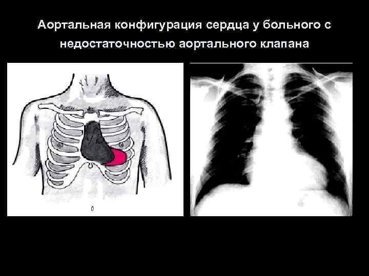 Аортальная конфигурация сердца у больного с недостаточностью аортального клапана 