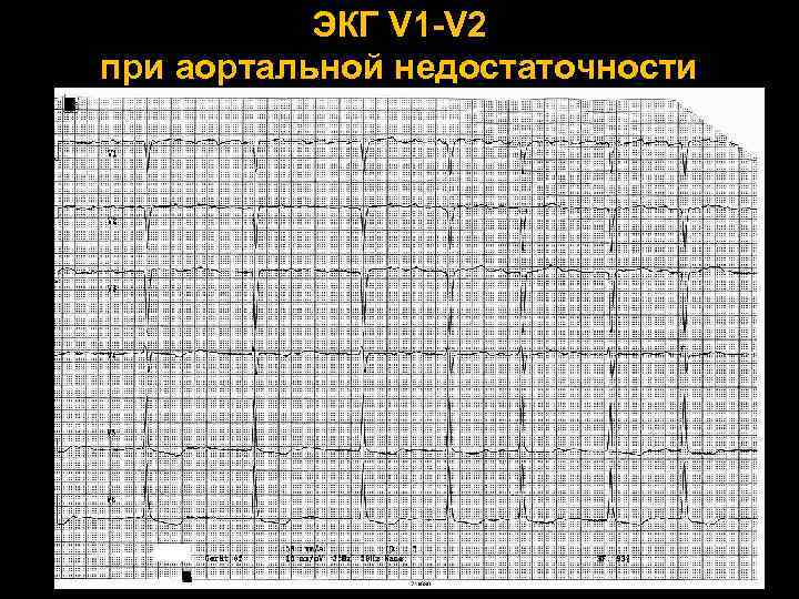 ЭКГ V 1 -V 2 при аортальной недостаточности 