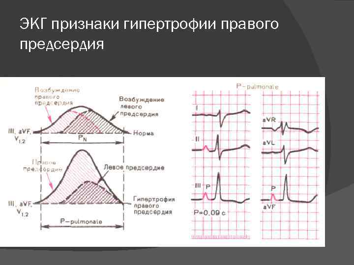 ЭКГ признаки гипертрофии правого предсердия 