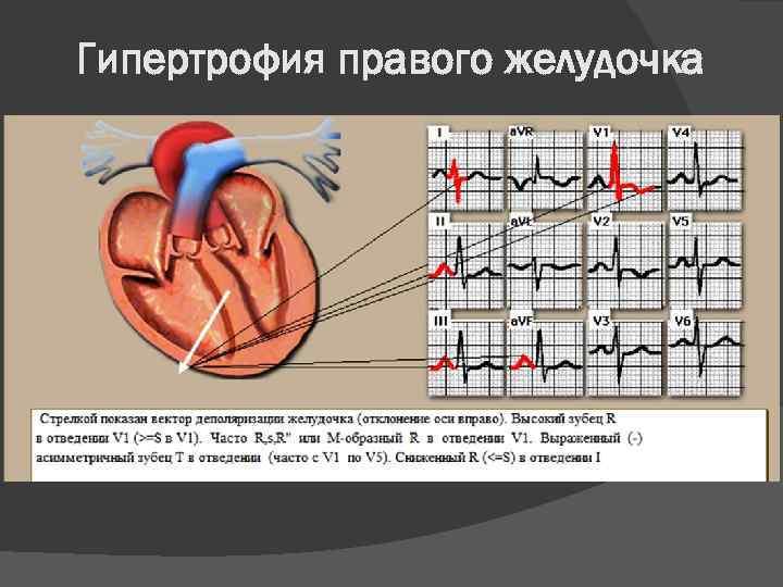 Гипертрофия правого желудочка 