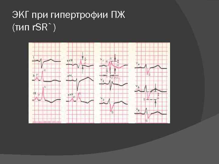 ЭКГ при гипертрофии ПЖ (тип r. SR`) 