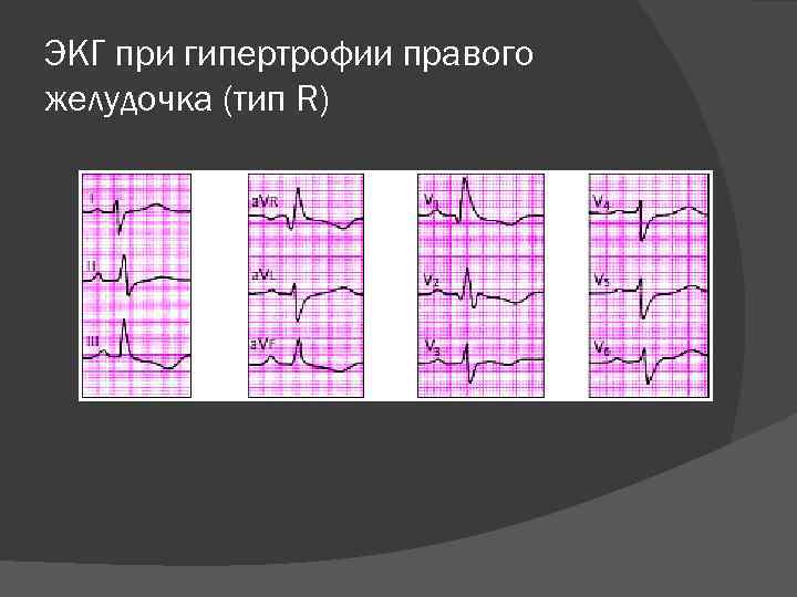 ЭКГ при гипертрофии правого желудочка (тип R) 