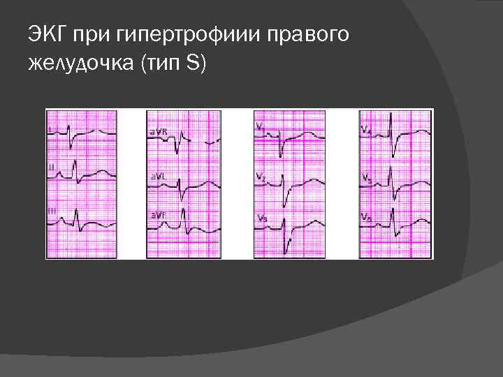 ЭКГ при гипертрофиии правого желудочка (тип S) 