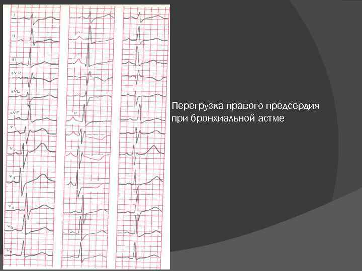 Перегрузка правого предсердия при бронхиальной астме 