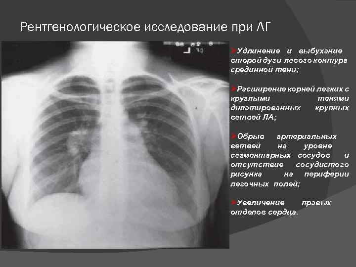 Рентгенологическое исследование при ЛГ ØУдлинение и выбухание второй дуги левого контура срединной тени; ØРасширение