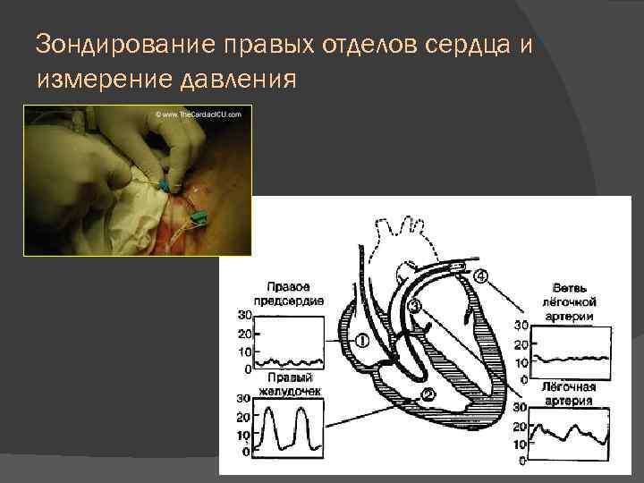 Зондирование правых отделов сердца и измерение давления 