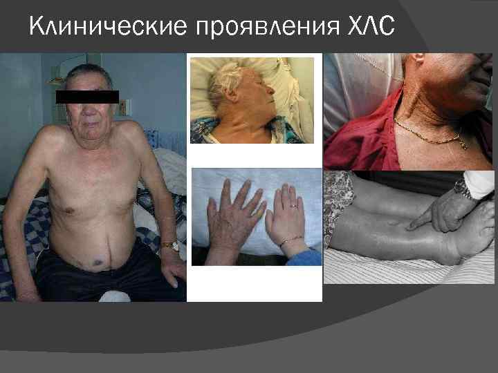 Клинические проявления ХЛС 