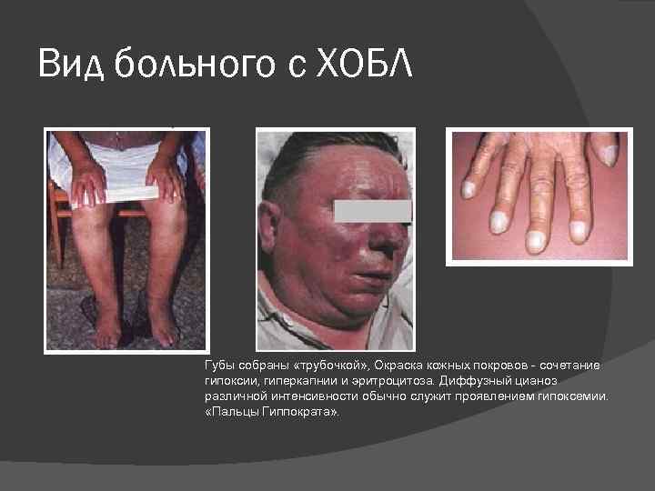 Вид больного с ХОБЛ Губы собраны «трубочкой» , Окраска кожных покровов - сочетание гипоксии,