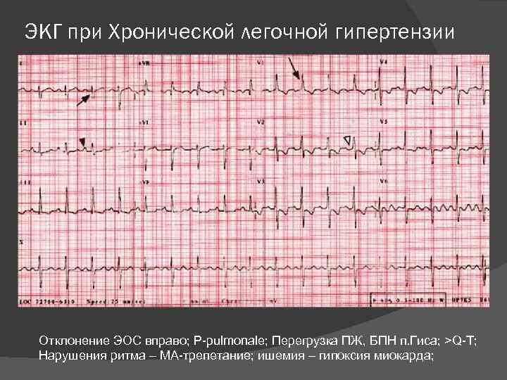 ЭКГ при Хронической легочной гипертензии Отклонение ЭОС вправо; P-pulmonale; Перегрузка ПЖ, БПН п. Гиса;
