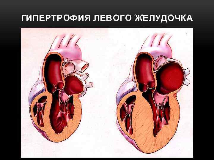 ГИПЕРТРОФИЯ ЛЕВОГО ЖЕЛУДОЧКА 