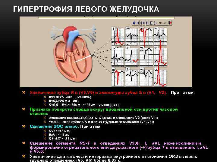ГИПЕРТРОФИЯ ЛЕВОГО ЖЕЛУДОЧКА Увеличение зубца R в (V 5, V 6) и амплитуды зубца