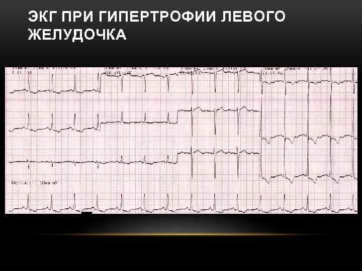 ЭКГ ПРИ ГИПЕРТРОФИИ ЛЕВОГО ЖЕЛУДОЧКА 