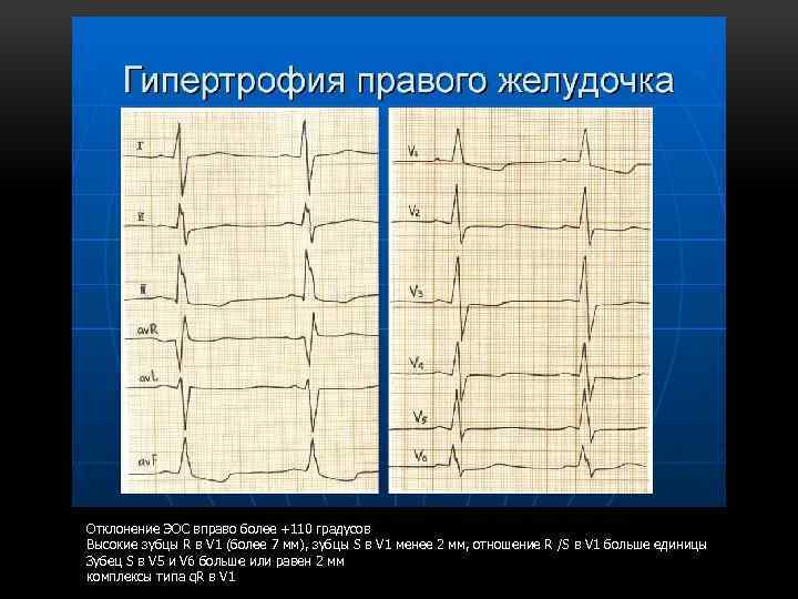Отклонение ЭОС вправо более +110 градусов Высокие зубцы R в V 1 (более 7