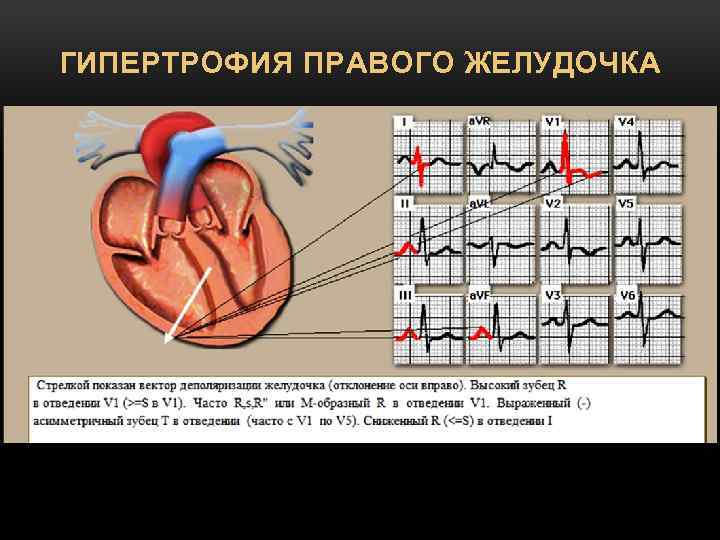 ГИПЕРТРОФИЯ ПРАВОГО ЖЕЛУДОЧКА 