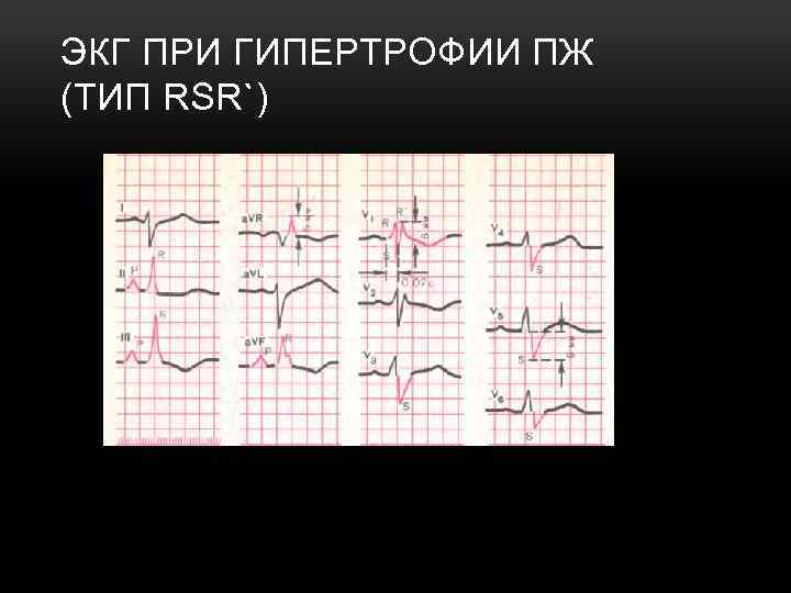 ЭКГ ПРИ ГИПЕРТРОФИИ ПЖ (ТИП RSR`) 