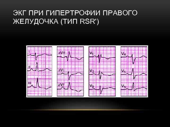 ЭКГ ПРИ ГИПЕРТРОФИИ ПРАВОГО ЖЕЛУДОЧКА (ТИП RSR') 