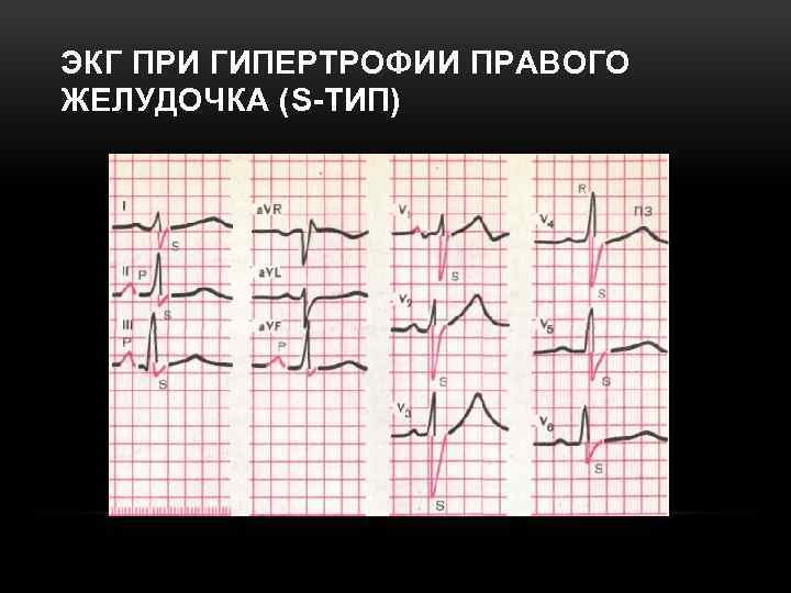 ЭКГ ПРИ ГИПЕРТРОФИИ ПРАВОГО ЖЕЛУДОЧКА (S-ТИП) 