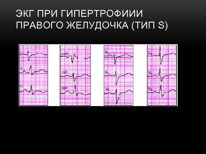 ЭКГ ПРИ ГИПЕРТРОФИИИ ПРАВОГО ЖЕЛУДОЧКА (ТИП S) 