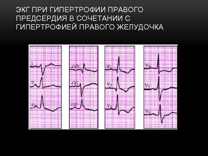 ЭКГ ПРИ ГИПЕРТРОФИИ ПРАВОГО ПРЕДСЕРДИЯ В СОЧЕТАНИИ С ГИПЕРТРОФИЕЙ ПРАВОГО ЖЕЛУДОЧКА 