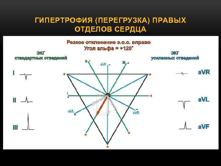 ГИПЕРТРОФИЯ (ПЕРЕГРУЗКА) ПРАВЫХ ОТДЕЛОВ СЕРДЦА 