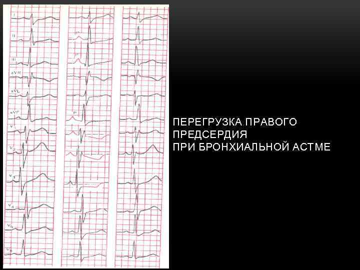 ПЕРЕГРУЗКА ПРАВОГО ПРЕДСЕРДИЯ ПРИ БРОНХИАЛЬНОЙ АСТМЕ 