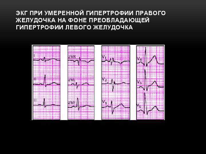 ЭКГ ПРИ УМЕРЕННОЙ ГИПЕРТРОФИИ ПРАВОГО ЖЕЛУДОЧКА НА ФОНЕ ПРЕОБЛАДАЮЩЕЙ ГИПЕРТРОФИИ ЛЕВОГО ЖЕЛУДОЧКА 