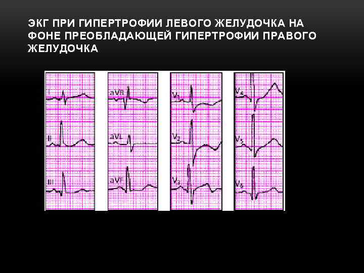 ЭКГ ПРИ ГИПЕРТРОФИИ ЛЕВОГО ЖЕЛУДОЧКА НА ФОНЕ ПРЕОБЛАДАЮЩЕЙ ГИПЕРТРОФИИ ПРАВОГО ЖЕЛУДОЧКА 