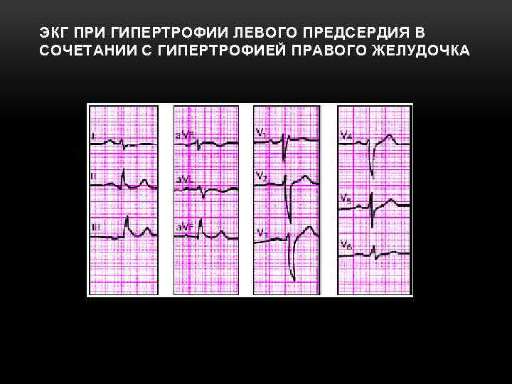 ЭКГ ПРИ ГИПЕРТРОФИИ ЛЕВОГО ПРЕДСЕРДИЯ В СОЧЕТАНИИ С ГИПЕРТРОФИЕЙ ПРАВОГО ЖЕЛУДОЧКА 