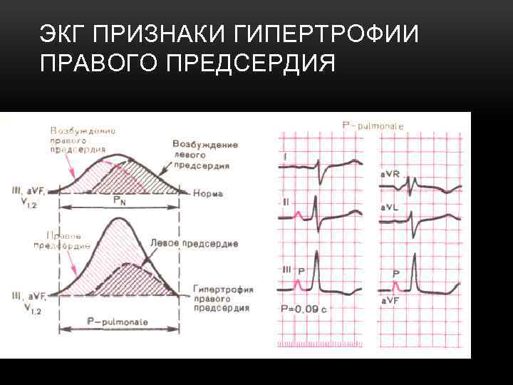 ЭКГ ПРИЗНАКИ ГИПЕРТРОФИИ ПРАВОГО ПРЕДСЕРДИЯ 