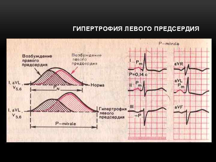 ГИПЕРТРОФИЯ ЛЕВОГО ПРЕДСЕРДИЯ 