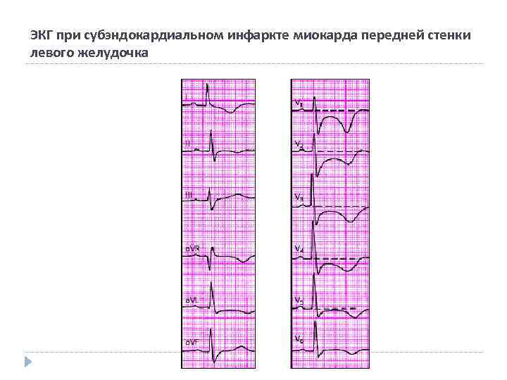 ЭКГ при субэндокардиальном инфаркте миокарда передней стенки левого желудочка 