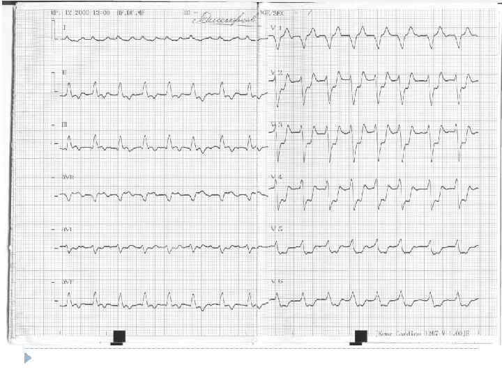 Ишемия боковой стенки на экг