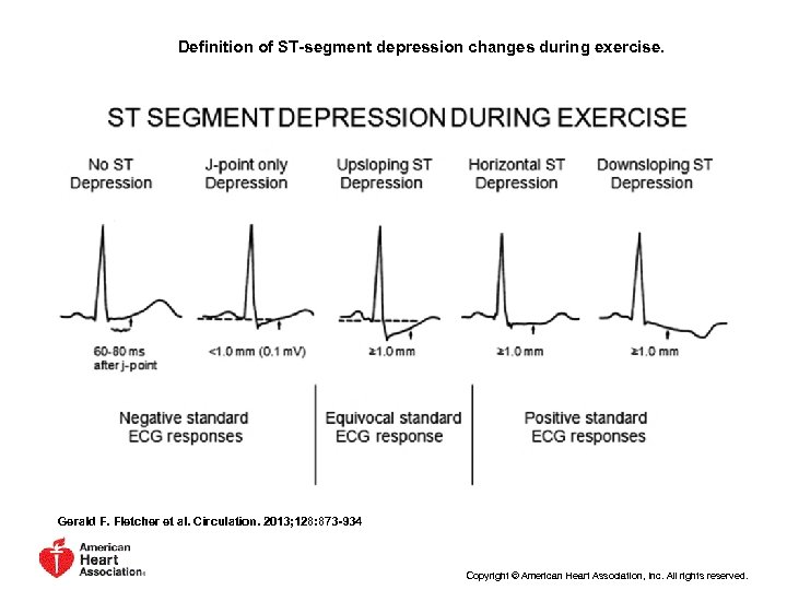 Definition of ST-segment depression changes during exercise. Gerald F. Fletcher et al. Circulation. 2013;