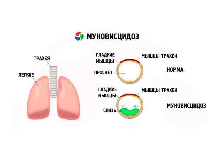 Муковисцидоз что это за заболевание. Симптомы легочного муковисцидоза. Легочная форма муковисцидоза. Муковисцидоз форма заболевания. Муковисцидоз легочно кишечная форма.