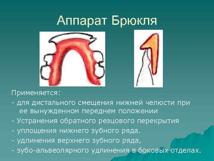 Ортодонтические аппараты механического действия презентация