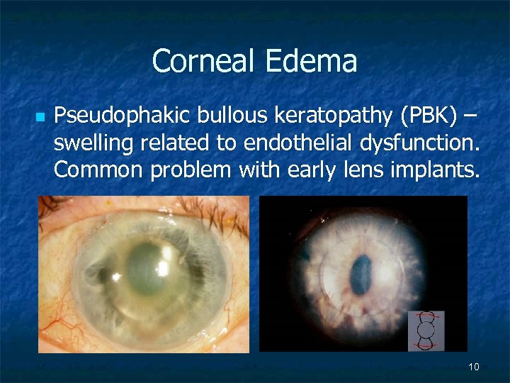 Corneal Edema n Pseudophakic bullous keratopathy (PBK) – swelling related to endothelial dysfunction. Common