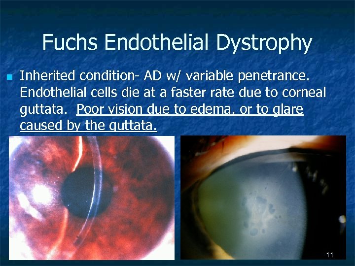 Fuchs Endothelial Dystrophy n Inherited condition- AD w/ variable penetrance. Endothelial cells die at