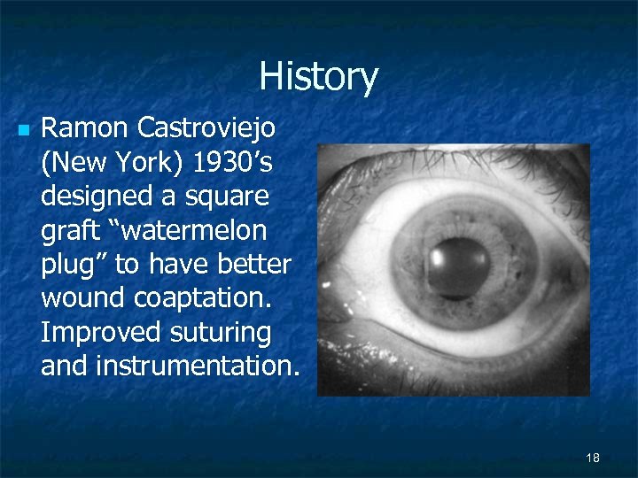 History n Ramon Castroviejo (New York) 1930’s designed a square graft “watermelon plug” to
