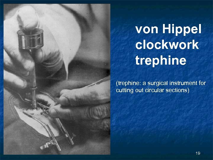 von Hippel clockwork trephine (trephine: a surgical instrument for cutting out circular sections) 19