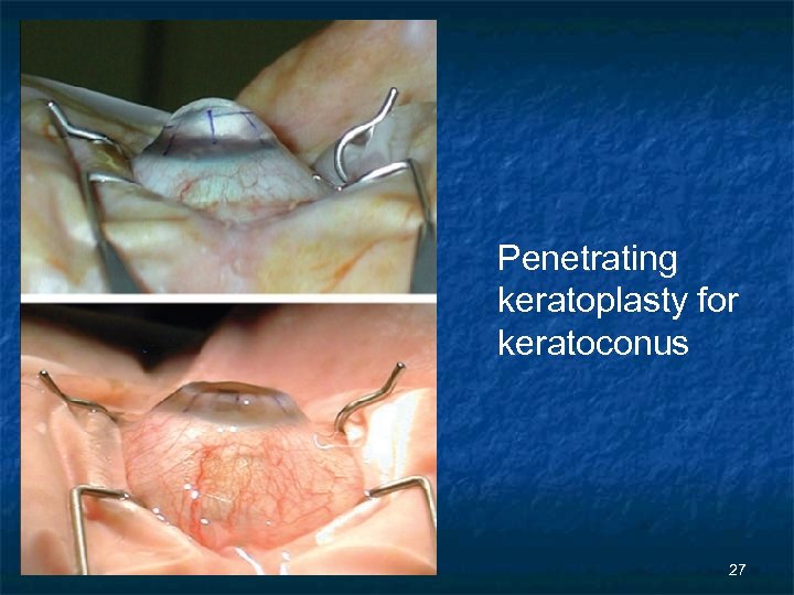 Penetrating keratoplasty for keratoconus 27 