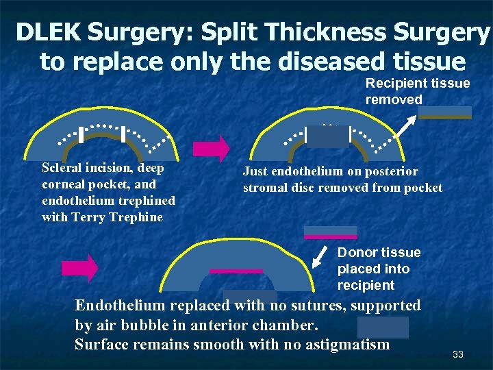 DLEK Surgery: Split Thickness Surgery to replace only the diseased tissue Recipient tissue removed