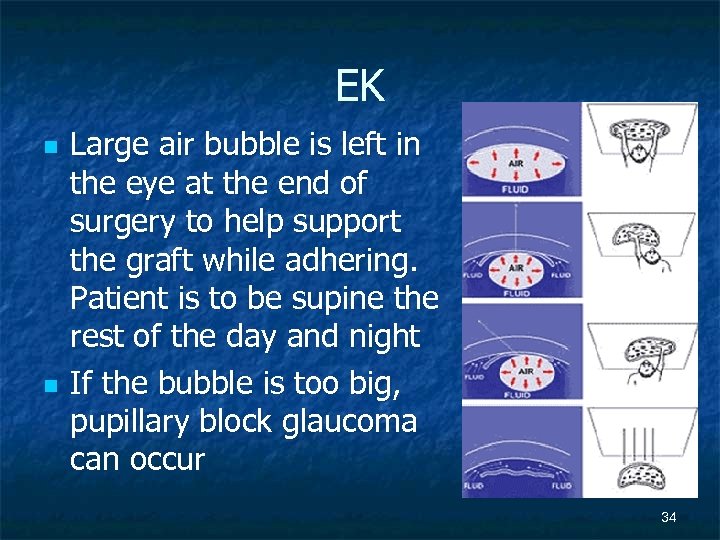 EK n n Large air bubble is left in the eye at the end