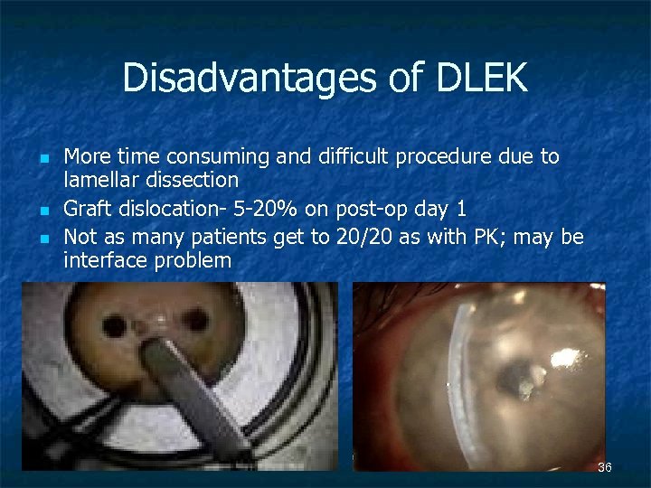 Disadvantages of DLEK n n n More time consuming and difficult procedure due to