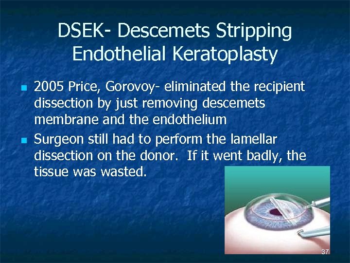 DSEK- Descemets Stripping Endothelial Keratoplasty n n 2005 Price, Gorovoy- eliminated the recipient dissection